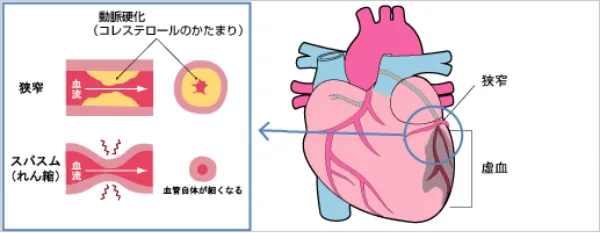 狭心症の仕組みを示す図。動脈硬化による血管の狭窄と、スパスム（攣縮）による血管の収縮によって心臓が虚血となる様子