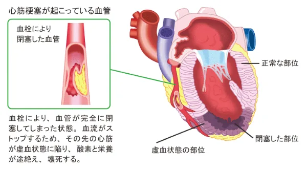 心筋梗塞の仕組みを示す図。血栓により冠動脈が完全に閉塞し、その先の心筋が虚血状態となり壊死する様子