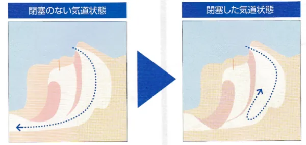 睡眠時無呼吸症候群の図。閉塞のない気道状態と、軟口蓋や舌で気道がふさがった閉塞した気道状態の比較